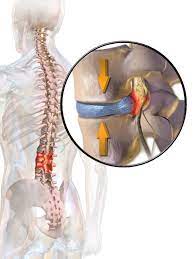 Ankylosing Spondylitis: