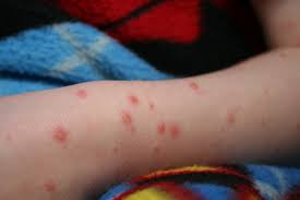 CHICKENPOX: