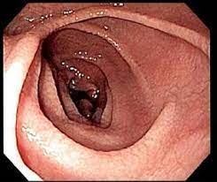 COELIAC DISEASE