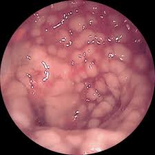 ULCERATIVE COLITIS: