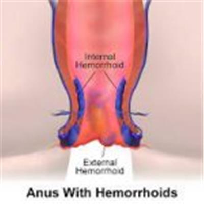 HEMORRHOIDS