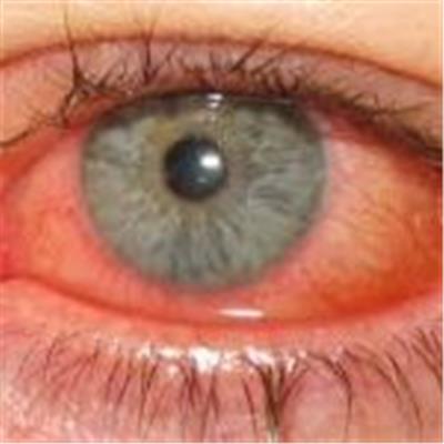 CONJUNCTIVITIS